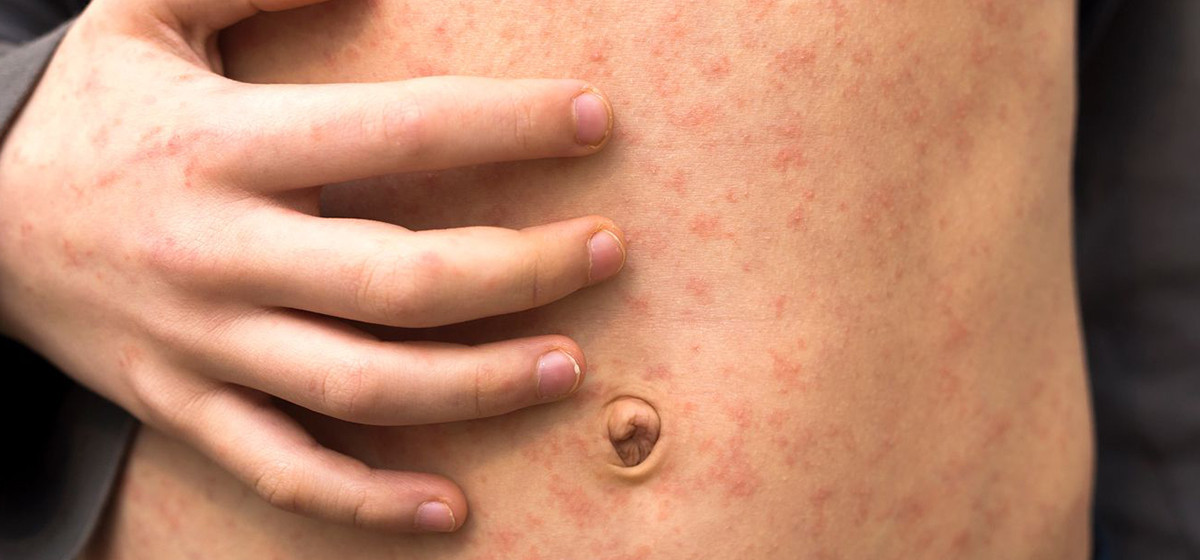 Government Issues Alert After Measles Cases Reported in Dhorpatan, Baglung